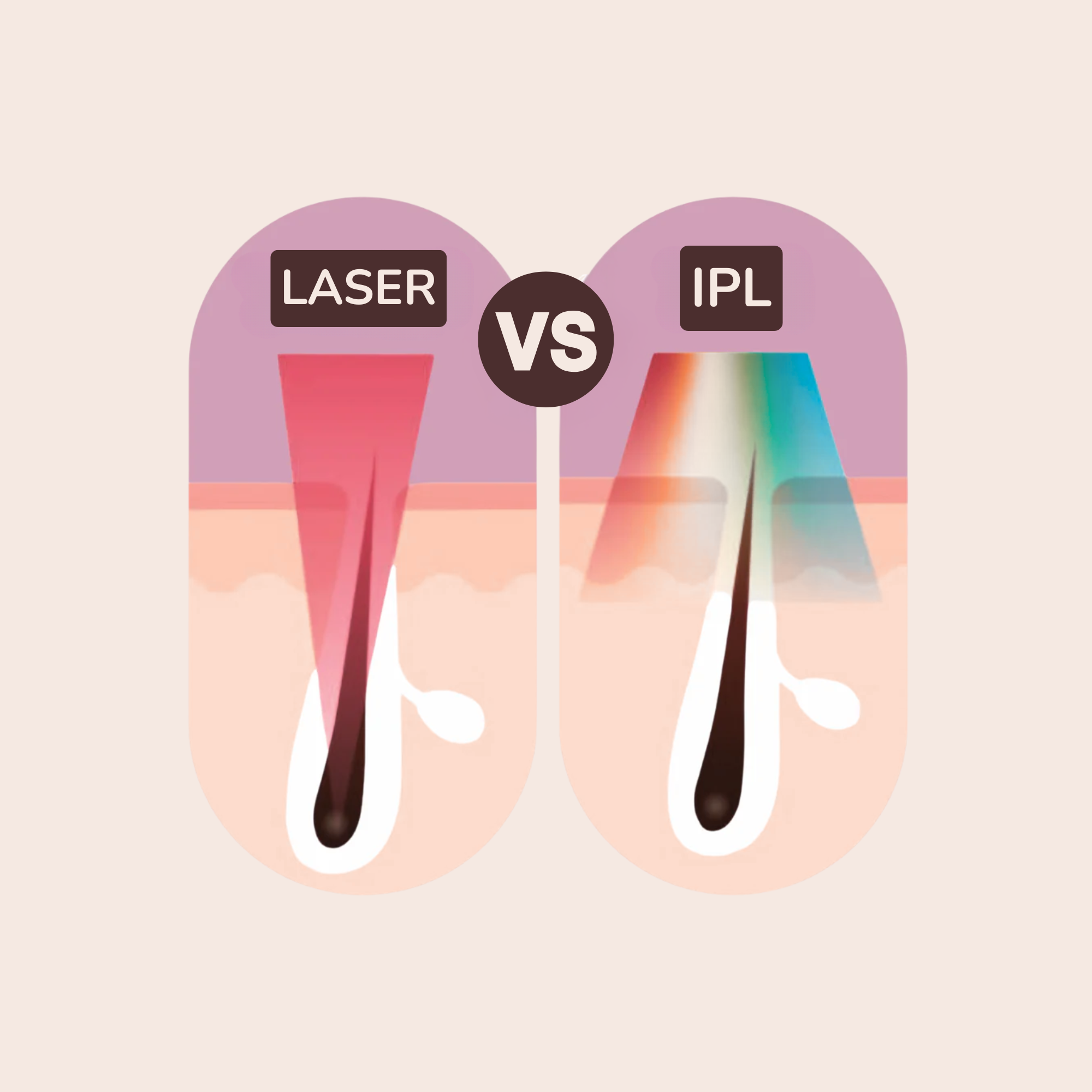 IPL ontharing vs laserontharing uitgelegd