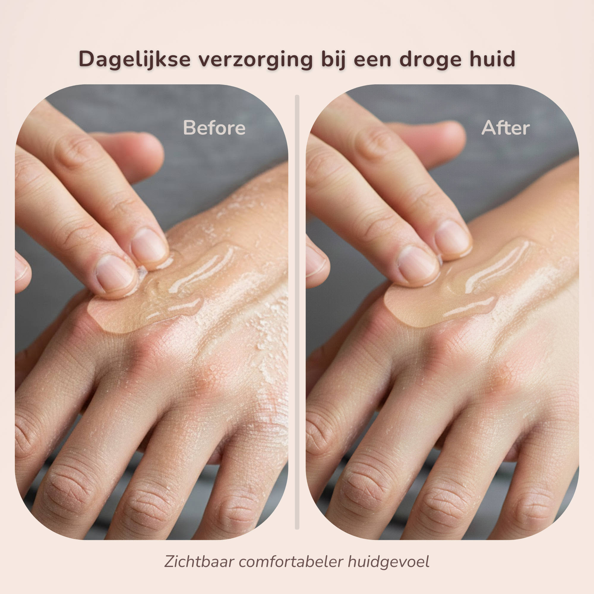 Before- & afterbeeld van hand met Laesera Aloë Vera Gel. Links een droge, trekkerige huid; rechts zichtbaar gehydrateerde en gekalmeerde huid na gebruik.