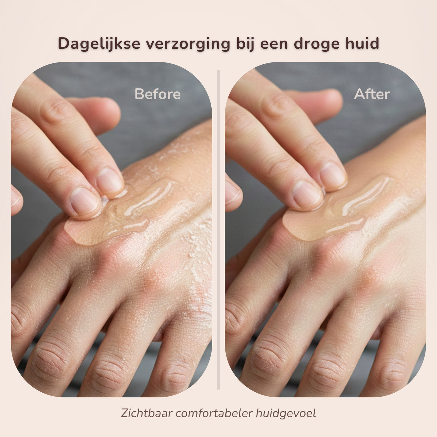 Voor en na resultaat van Laesera aloe vera gel bij droge huid met zichtbaar comfortabeler huidgevoel