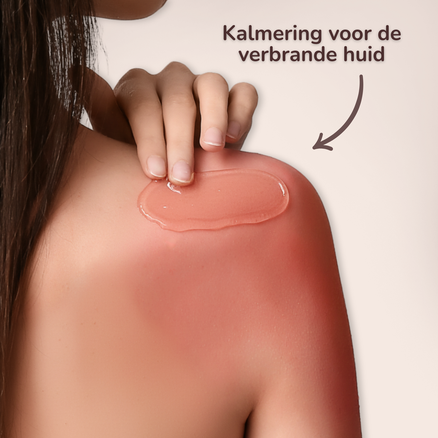 Vrouw brengt verkoelende gel aan op een verbrande schouder voor verlichting na zonverbranding.
